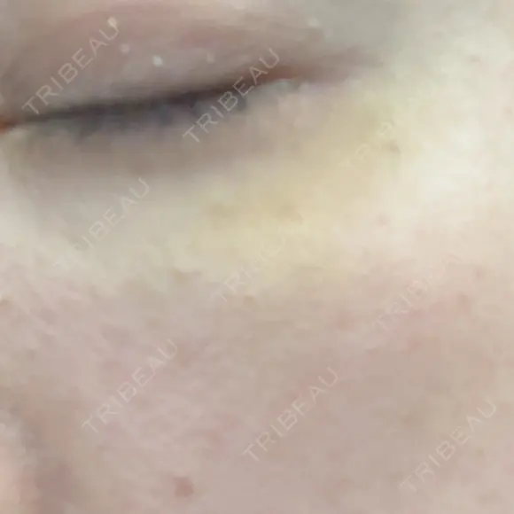 ボトックス（目尻） PRO CLINIC プロクリニック 銀座院 DAY 8 メイン用
