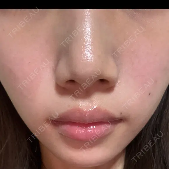 フォトRF 湘南美容クリニック 長野院 AFTER メイン用