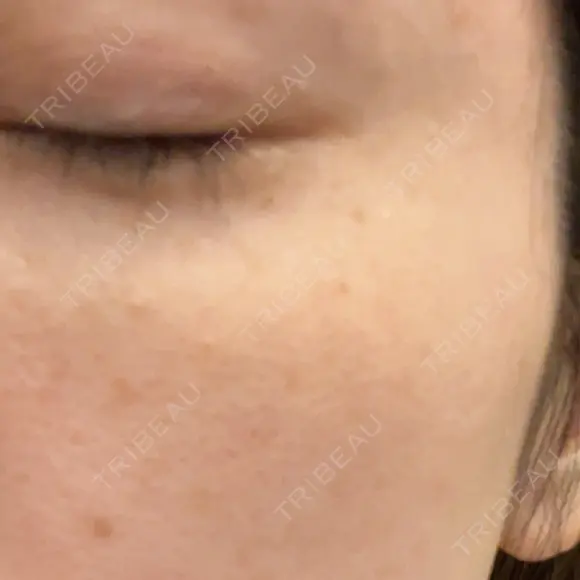 ボトックス（目尻） PRO CLINIC プロクリニック 銀座院 DAY 11 メイン用