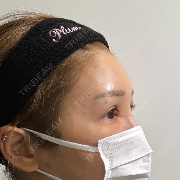 脂肪注入（額） plume clinic DAY 30 メイン用