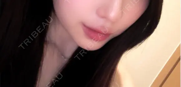 ヒアルロン酸注入（唇） / ボトックス（口角） / RF（高周波）たるみ治療 ルラ美容クリニック 京都院 AFTER メイン用