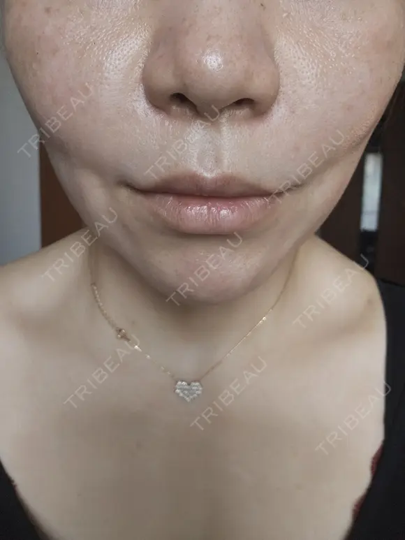 その他 MKクリニック 日本橋院 AFTER メイン用