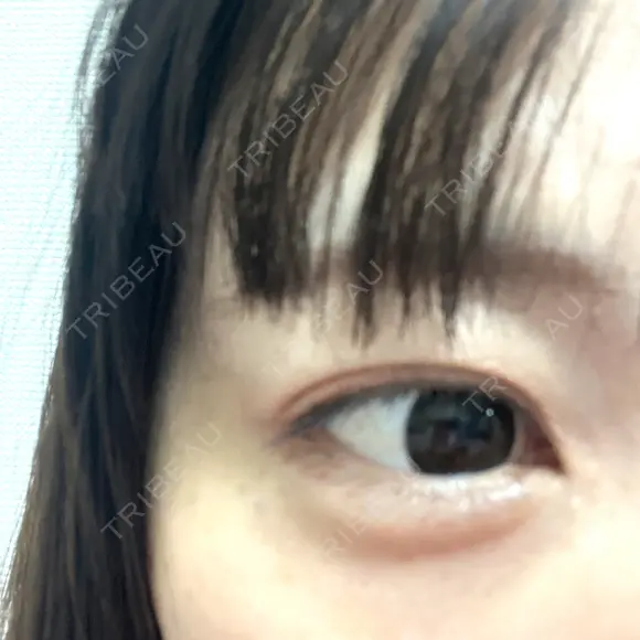 人中短縮 / 小鼻縮小（非切開） / ヒアルロン酸注入（涙袋） / ヒアルロン酸注入（唇） / ヒアルロン酸注入（目の下） / ボトックス（人中） Evergreen medical clinic AFTER メイン用
