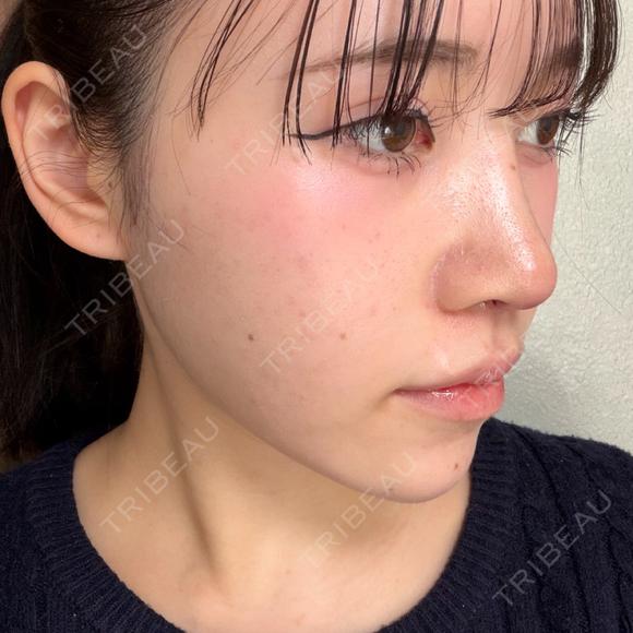 隆鼻術 / 軟骨移植 / 鼻尖形成（非切開） / 鼻中隔延長（非切開） WOM CLINIC GINZA （ワム クリニック ギンザ） DAY 9 メイン用