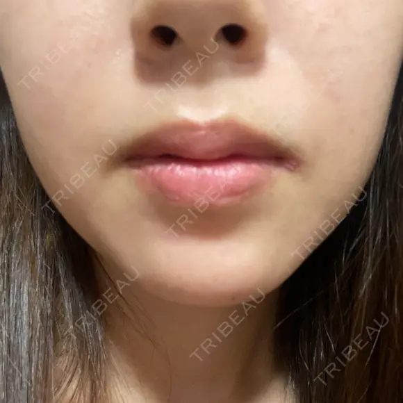 ハイフ（顔） 共立美容外科 大阪本院 DAY 3 メイン用