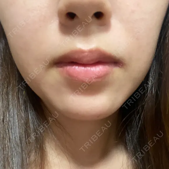 ハイフ（顔） 共立美容外科 大阪本院 DAY 4 メイン用