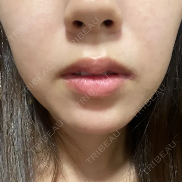 ハイフ（顔） 共立美容外科 大阪本院 DAY 5 メイン用