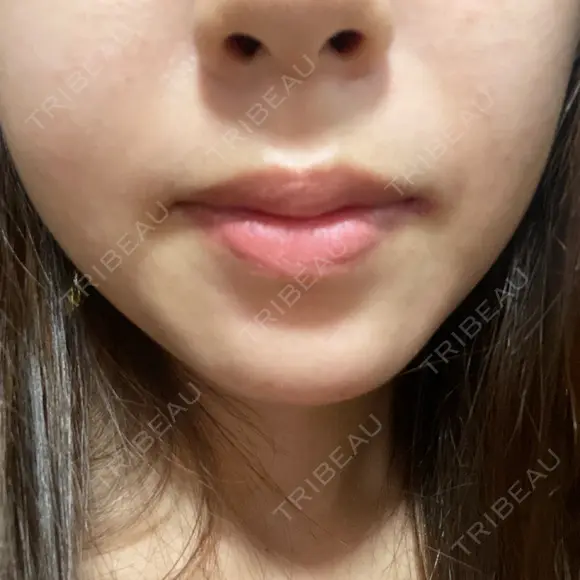 ハイフ（顔） 共立美容外科 大阪本院 DAY 6 メイン用