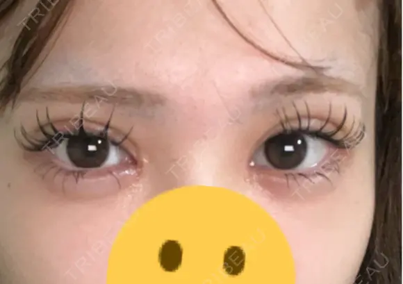 二重埋没 / 目頭切開 Stand by Beauty Clinic DAY 4 メイン用