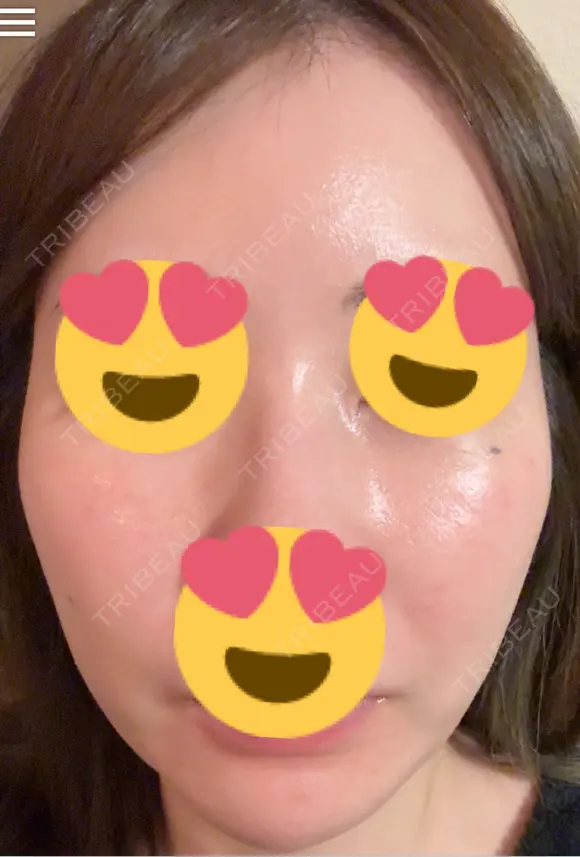 フラクショナルレーザー（毛穴・ニキビ跡） おおかみ美容のクリニック 新宿院 DAY 3 メイン用