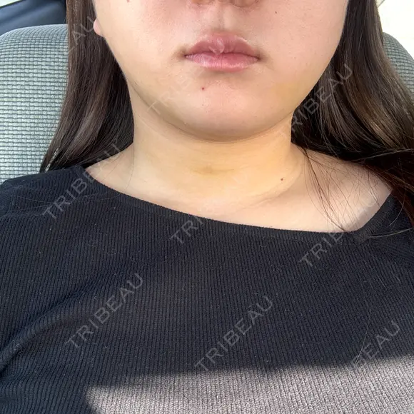 糸リフト / 脂肪吸引（顔） / ジョールファット除去 Wing clinic 豊中駅前院 DAY 4 メイン用