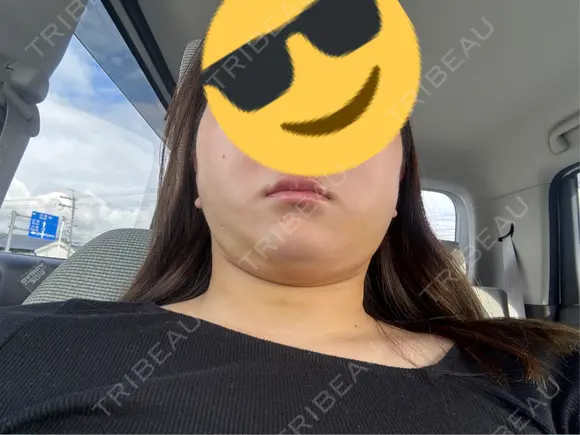 糸リフト / 脂肪吸引（顔） / ジョールファット除去 Wing clinic 豊中駅前院 DAY 4 メイン用