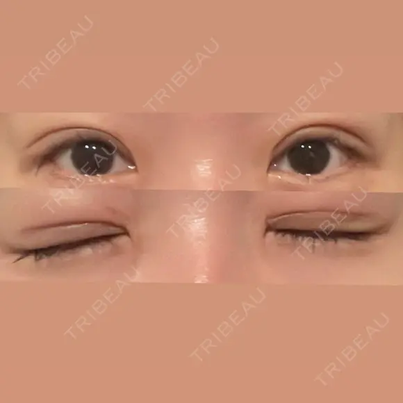 二重切開 / 眼瞼下垂（切開） / 上まぶたたるみ取り eクリニック 福岡院 DAY 10 メイン用