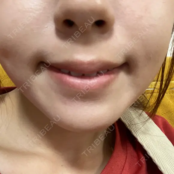 ハイフ（顔） 共立美容外科 大阪本院 DAY 8 メイン用