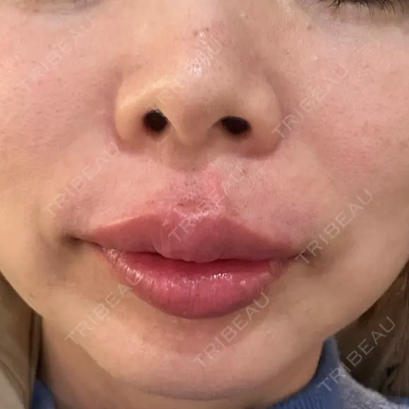 ヒアルロン酸注入（唇） KIMI CLINIC 形成・美容外科 DAY 0 メイン用
