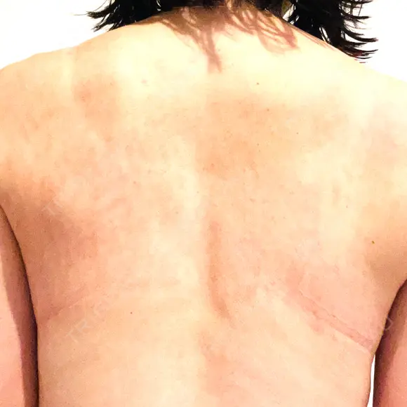 ピコフラクショナルレーザー（毛穴・ニキビ跡） ルラ美容クリニック 広島院 DAY 6 メイン用