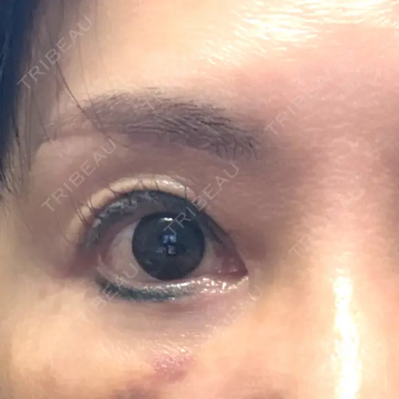 眉下切開 MOMO CLINIC DAY 19 メイン用