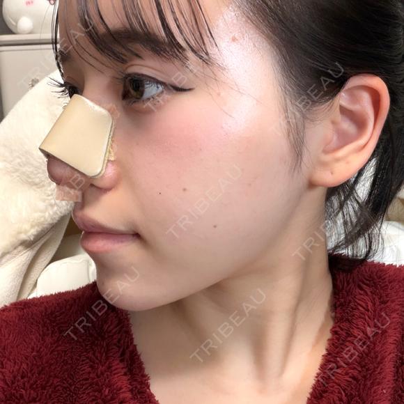 隆鼻術 / 軟骨移植 / 鼻尖形成（非切開） / 鼻中隔延長（非切開） WOM CLINIC GINZA （ワム クリニック ギンザ） DAY 11 メイン用