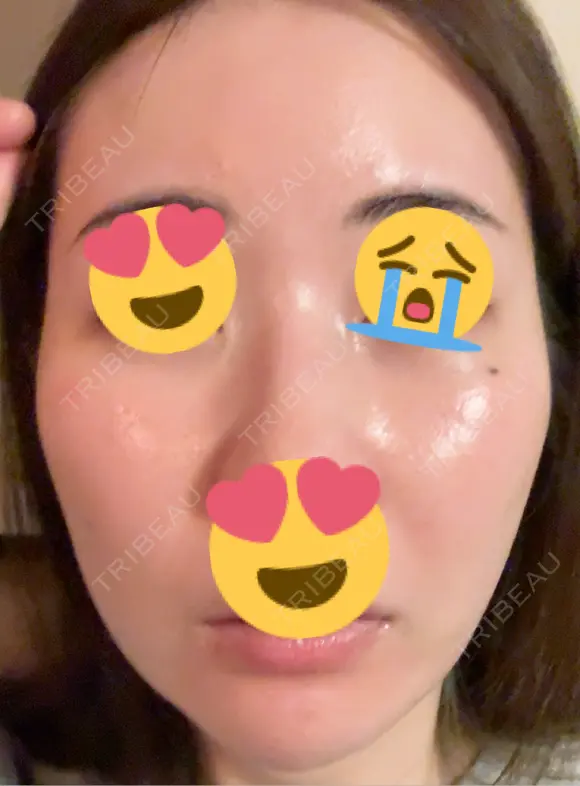 フラクショナルレーザー（毛穴・ニキビ跡） おおかみ美容のクリニック 新宿院 DAY 5 メイン用