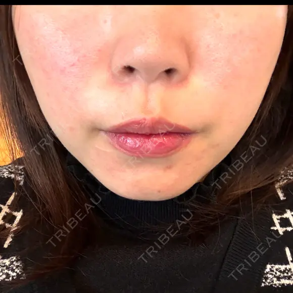 脂肪溶解注射（顔） BAO CLINIC 神戸院 DAY 6 メイン用