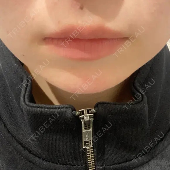 ヒアルロン酸注入（あご） R Beauty CLINIC 名古屋院 AFTER メイン用