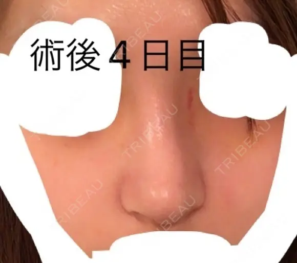隆鼻術 / 鼻尖形成（切開） / 鼻中隔延長（切開） / 鼻尖縮小 FROM B整形外科 (旧バウム整形外科) DAY 4 メイン用
