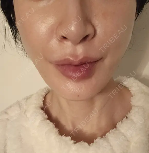 糸リフト 形成外科と美容外科のクリニック池袋 DAY 0 メイン用