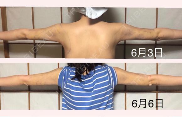 脂肪吸引（二の腕） ヨンセスリムライン DAY 9 メイン用