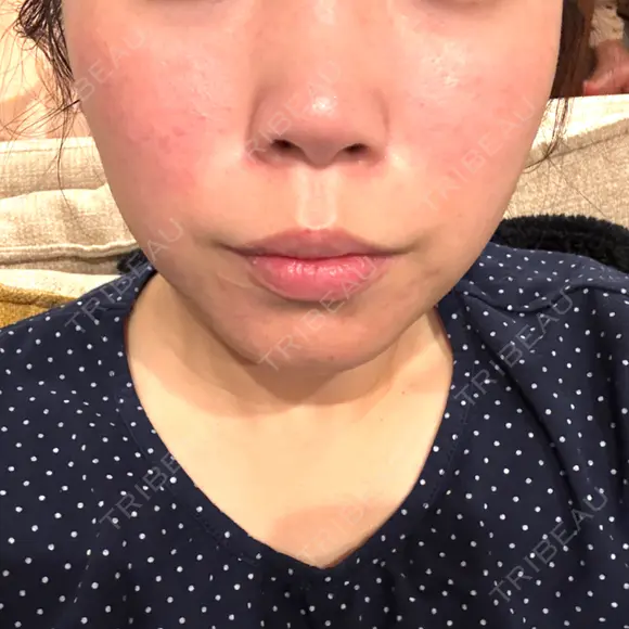 脂肪溶解注射（顔） BAO CLINIC 神戸院 DAY 6 メイン用