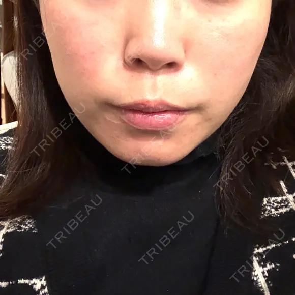 脂肪溶解注射（顔） BAO CLINIC 神戸院 DAY 6 メイン用