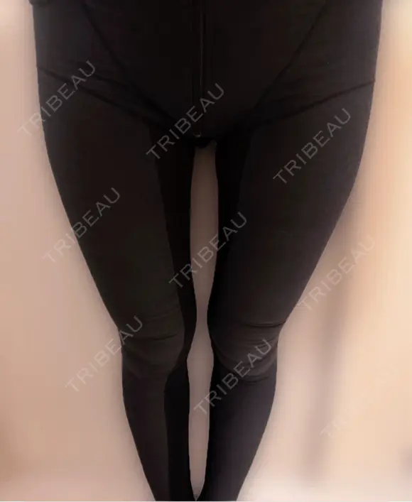 脂肪吸引（脚） / 脂肪吸引（お尻） アムルーズ美容外科クリニック 横浜院 DAY 7 メイン用