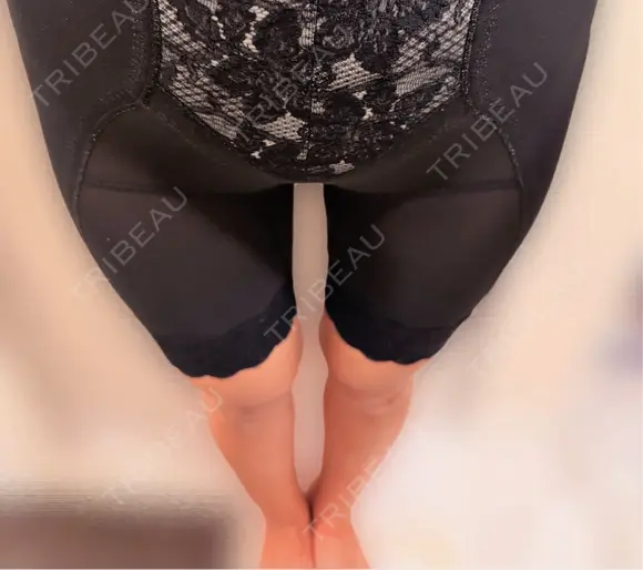 脂肪吸引（脚） / 脂肪吸引（お尻） アムルーズ美容外科クリニック 横浜院 DAY 7 メイン用