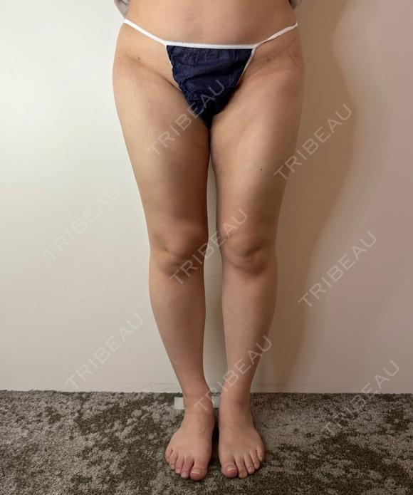 脂肪吸引（顔） / 脂肪吸引（脚） / 脂肪吸引（お尻） GAYA body design clinic AFTER メイン用