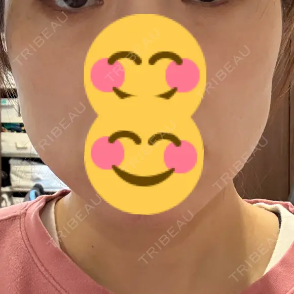 オリジオ Chloe Cheongdam Clinic （クロエチョンダムクリニック） DAY 7 メイン用
