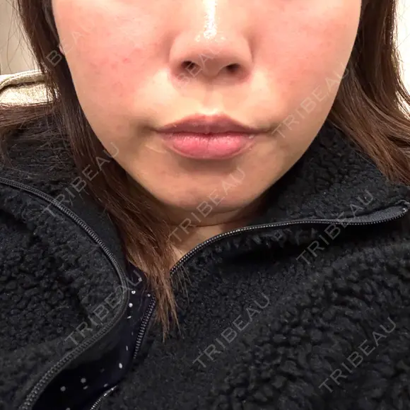 脂肪溶解注射（顔） BAO CLINIC 神戸院 AFTER メイン用