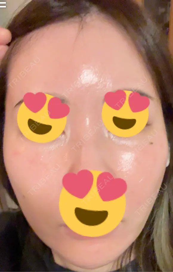 フラクショナルレーザー（毛穴・ニキビ跡） おおかみ美容のクリニック 新宿院 DAY 6 メイン用