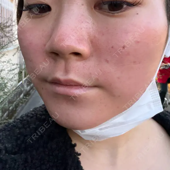 ダーマペン BELINDA CLINIC（ベリンダクリニック）新宿院 DAY 0 メイン用