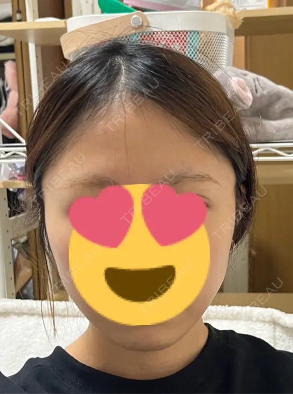 脂肪吸引（顔） / 下まぶたの脂肪取り 東京脂肪吸引クリニック DAY 28 メイン用