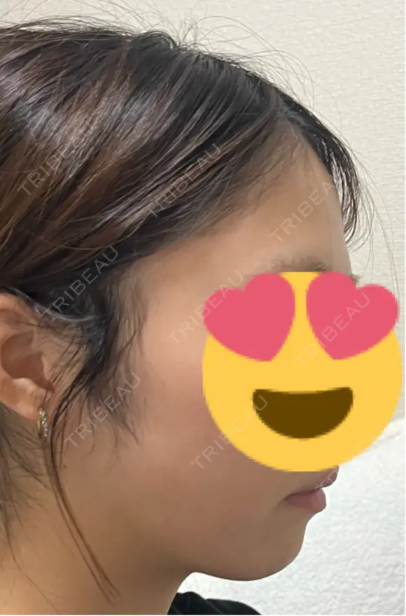 脂肪吸引（顔） / 下まぶたの脂肪取り 東京脂肪吸引クリニック DAY 28 メイン用