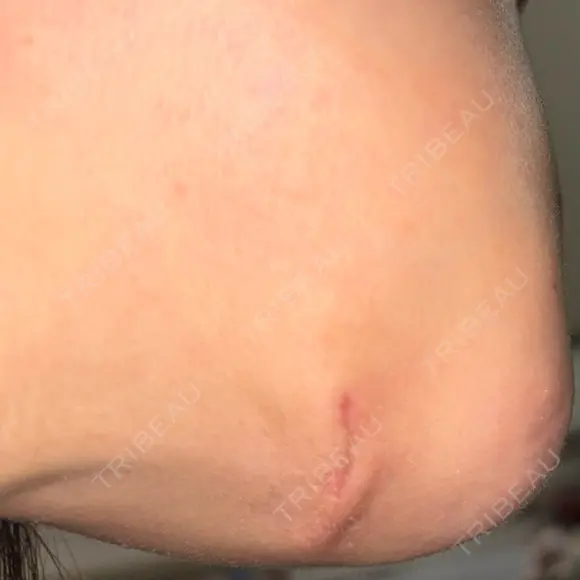 脂肪吸引（顔） / ネックリフト リラ・クラニオフェイシャル・クリニック DAY 28 メイン用