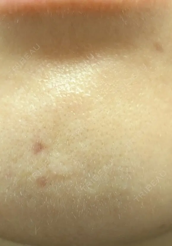 ほくろ・いぼ除去レーザー（肌） プライベートスキンクリニック 梅田本院 AFTER メイン用