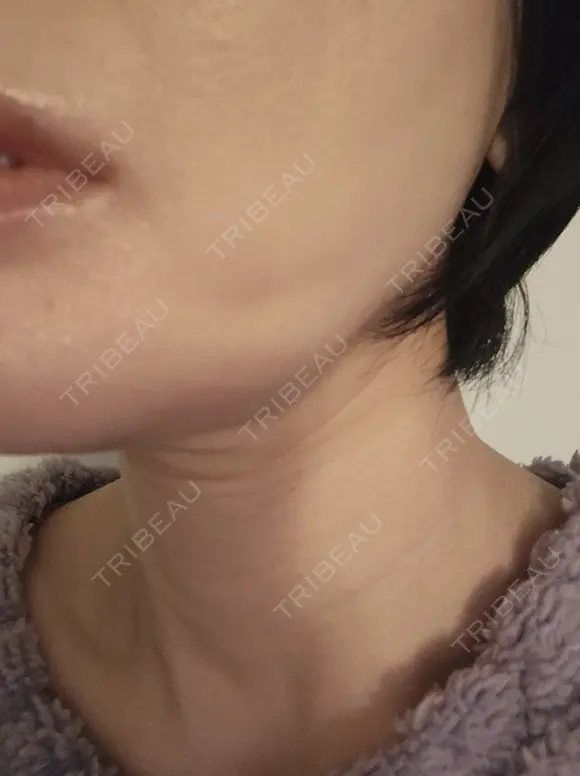 糸リフト 形成外科と美容外科のクリニック池袋 DAY 4 メイン用