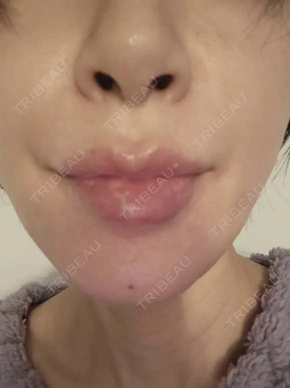 糸リフト 形成外科と美容外科のクリニック池袋 DAY 4 メイン用