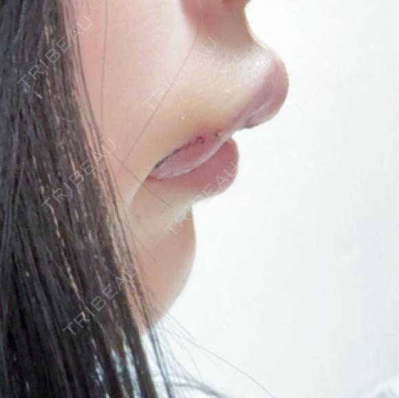 口唇縮小術 / 口角挙上 PRISM Beauty Clinic 町田院 AFTER メイン用