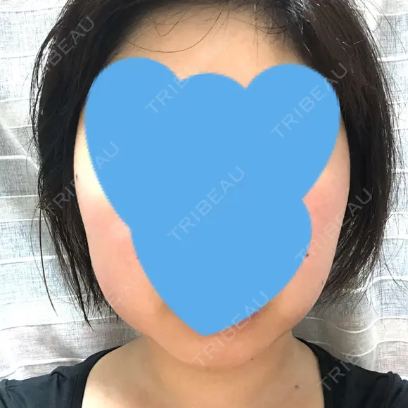 脂肪吸引（顔） GRACIA clinic 【グラシアクリニック】 DAY 23 メイン用