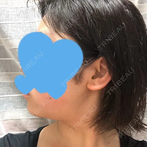 脂肪吸引（顔） GRACIA clinic 【グラシアクリニック】 DAY 23 メイン用
