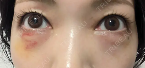 ヒアルロン酸注入（涙袋） / ヒアルロン酸注入（鼻） / 肌ヒアルロン酸注入（たるみ・シワ改善） / ヒアルロン酸注入（あご） / 豊胸（ヒアルロン酸） / ヒアルロン酸注入（唇） / ヒアルロン酸溶解 / ヒアルロン酸注入（額） / ヒアルロン酸注入（頬） / ヒアルロン酸注入（目の下） / ヒアルロン酸注入（こめかみ） / ヒアルロン酸注入（首） / ヒアルロン酸注入（耳たぶ） / ヒアルロン酸注入（鼻翼基部） MKクリニック 日本橋院 DAY 7 メイン用