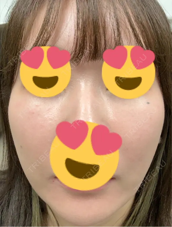 フラクショナルレーザー（毛穴・ニキビ跡） おおかみ美容のクリニック 新宿院 DAY 8 メイン用