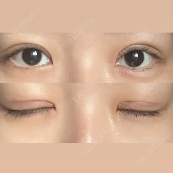 二重切開 / 眼瞼下垂（切開） / 上まぶたたるみ取り eクリニック 福岡院 DAY 14 メイン用