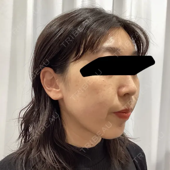 ピーリング（ニキビ・毛穴） / ルメッカ 大美会クリニック 梅田院 DAY 0 メイン用